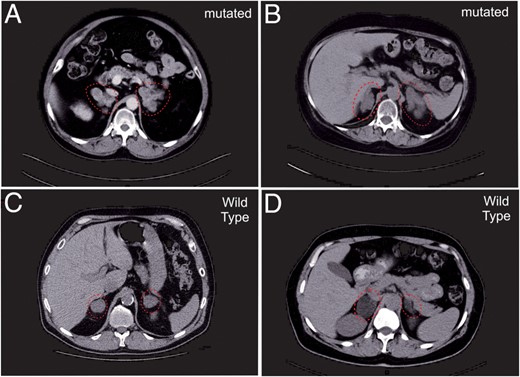 CT scan of ARMC5 mutated and wild-type PBMAH patients.