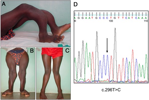 Skeletal deformities and mutation analysis in affected members of family 1.