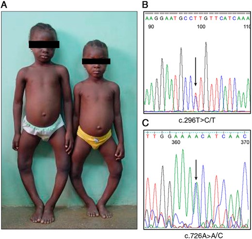 Skeletal deformities and mutation analysis in affected members of family 2.