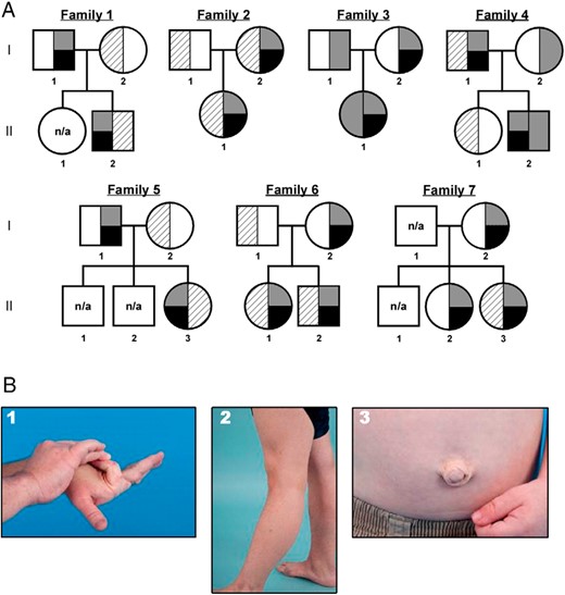 CAH-X pedigrees and clinical phenotypes.