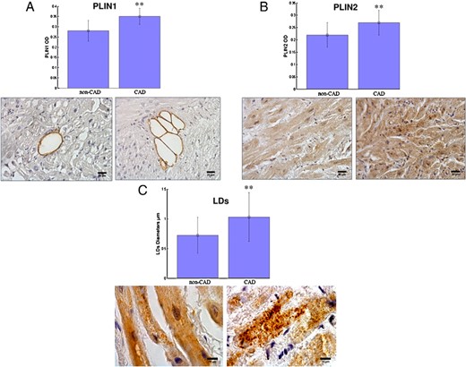 Representative images of immunohistochemical staining and histograms showing a greater expression of PLIN1 (A) and PLIN2 (B) in the right atrium of patients with CAD compared to patients without CAD (non-CAD) (**, P <.01; ×200 magnification; scale bar, 25 μm).