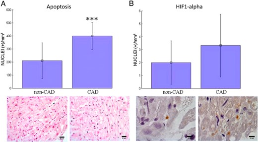 Apoptotic cardiomyocytes (A) and HIF1 alpha (B) positive cardiomyocytes at immunohistochemistry analyses in the right atrium of patients without CAD (non-CAD) and with CAD (***, P <.001).