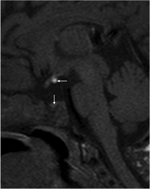 MRI of the patient showing the small anterior pituitary of 2 mm (vertical arrow) and the ectopic posterior lobe (horizontal arrow).