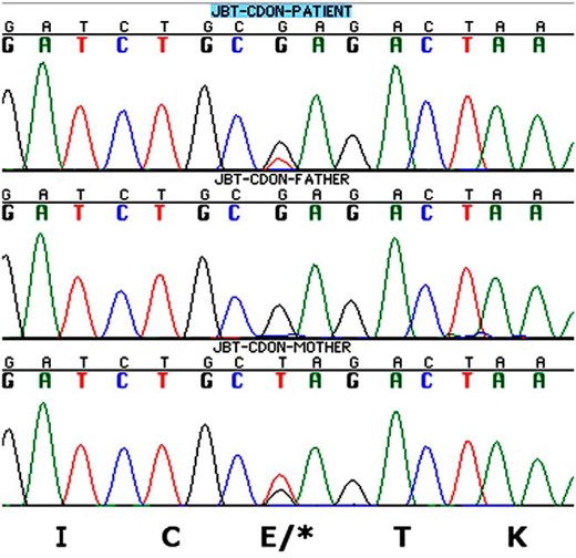 Representative chromatograms of the heterozygous c.2764T>C, Glu922Ter CDON mutation showing patient (top), father (middle), and mother (bottom).
