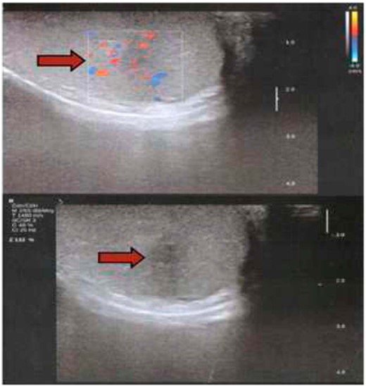 Infiltrative lesions of the testicles are represented on Doppler US by pseudonodular lesions that are poorly limited and hypoechoic with low vascularization.