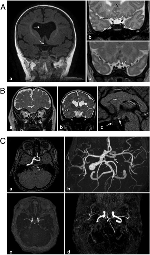 MRI features of patients with neonatal hypothalamic adipsic hypernatremia syndrome (A and B) or CDI (C). Aa, Patient 5; T1-weighted coronal view: septal agenesis and chiasma optic hypoplasia (arrow). Ab and Ac, T2-weighted coronal views: optic nerve hypoplasia (arrow). Ab, patient 1; Ac, normal optic nerve (arrow). Ba, Patient 1; coronal T2-weighted image: interdigitation of the frontal gyri in the midline, agenesis of the olfactory bulbs with existing olfactory gyri, hypoplastic orbital optic nerves. Bb, Patient 3; coronal T2-weighted image through ventricle frontal horns. Square frontal horns with (right) heterotopic subependymal gray matter nodules (arrowheads), and (left) an abnormal deep gyrus (arrow) coming into contact with the lateral wall of the ventricle (without a schizencephalic appearance). Bc, Patient 8; sagittal T1-weighted image: ectopic PP and agenesis of the pituitary stalk and anterior pituitary gland. C, Magnetic resonance time-of-flight angiography. Ca and Cb, Patient 10; agenesis of the cervical and intrapetrous segments of the left internal carotid artery, with an absence of normal flow void in the left ipsilateral cavernous sinus, and with a transsellar anastomotic vessel connecting with the intracavernous internal carotid artery. Cc and Cd, Normal appearance.
