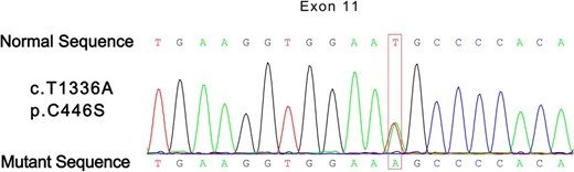 Partial electropherogram showing the heterozygosis for c.1336T>A transition in exon 11, codon 446.