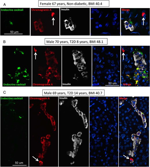 Examples of CPHN cells in pancreas from an OND subject (A) and two OT2D subjects (B, C). Individual layers stained for endocrine cocktail (glucagon, somatostatin, pancreatic polypeptide, and ghrelin) (green), chromogranin A (red), insulin (white), and DAPI (blue) are shown along with the merged image. Arrows indicate CPHN cells. Scale bar, 50 μm.