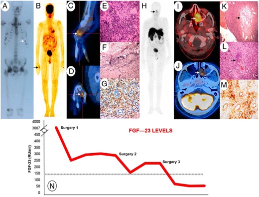 A, Tc-99m-MDP bone scan showing increased tracer uptake at multiple sites. B, Whole-body 18F-FDG-PET scan revealing FDG avid soft tissue thickening over the radial and dorsal aspect of the head of the right second metacarpal (SUVmax = 2.5). C and D, Fused 18F-FDG-PET and CT of the right hand in sagittal (C) and coronal (D) planes. E, Histological examination of metacarpal lesion showing diffuse proliferation of bland tumor cells in a patternless arrangement around vessels (F) with bluish smudgy matrix. G, Vimentin positivity on immunohistochemistry. H, Whole-body Ga-68-DOTANOC-PET scan showing avid tracer uptake within left nasal cavity lesion (2.9 × 2.0 cm;, SUVmax, 3.9). I, Fused Ga-68 DOTANOC PET and CT scan head. J, 18F-FDG-PET SPECT CT head axial imaging demonstrates the left nasal cavity lesion with a low SUV uptake (SUV max = 2.1). K, Histological examination of nasal lesion showing bland tumor cells with fibromyxoid stroma, hemangiopericytomatous pattern of vasculature (arrow). L, Smudgy matrix (arrow). M, Immunohistochemistry shows strong positive staining for somatostatin receptor subtype 2 A (SSTR2A). N, Graph depicting the trends in FGF-23 levels over time.