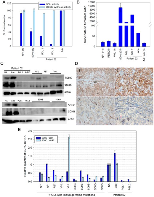 Patient PGLs (PGL1 and 2), but not the adenoma (Ade), show disruptions of SDH function with decreased SDHC expression. A, Enzymatic activity of SDH and citrate synthase were measured and compared to PPGLs from patients with known germline mutations (number of cases in parentheses). B, Succinate and fumarate were quantified by LC-MS/MS and compared to adrenal adenomas (Adr. ade), and PPGLs from patients with known germline mutations (number of cases in parentheses). C, Western blot analysis of SDHC and SDHB normalized to x-actin for tissue extracts from the patient's tumors and normal adrenal (NA), and PPGLs with known germline mutations (as indicated in the top row). D, Immunohistochemistry for SDHB: 1-normal adrenal cortex (ac) and medulla (am), as well as the 2-adenoma, show strong cytoplasmatic granular staining of SDHC, whereas 3-PGL1, and 4-PGL2 only show weak staining. e, endothelial cells. E, Relative expression of SDHC normalized to β-actin or HPRT1 in the same tissues analyzed in C. Primers and antibodies used in this study are listed in Supplemental Figure 1.