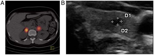 A, I-131 meta-iodobezylguanidine positron emission tomography–computed tomography revealed bilateral adrenal masses with increased tracer accumulation suggesting bilateral pheochromocytoma. B, Thyroid ultrasound showed a 4-mm hypoechogenic nodule in the left thyroid lobe. D, diameter.