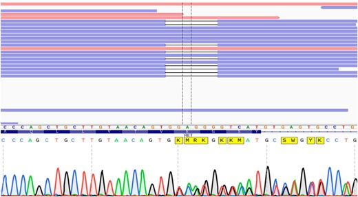 A, Visualization of RET sequencing exon 7 (amino acids on blue background) and right flanking intron with the Integrative Genomics Viewer. Reads that match the reference sequence are displayed in blue and red. Deletions are indicated with a black dash (—). Exome sequencing revealed a heterozygous in-frame deletion of 6-bp (c.1512_1517delGGAGGG)/2 amino acids (glutamic acid and glycine). B, Sanger sequencing confirmed the mutation.