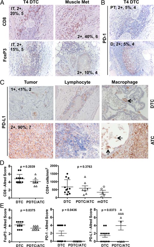 Immunohistochemical analysis of tumor-associated T cells and the PD-1 checkpoint pathway and advanced pT4 DTC and ATC.