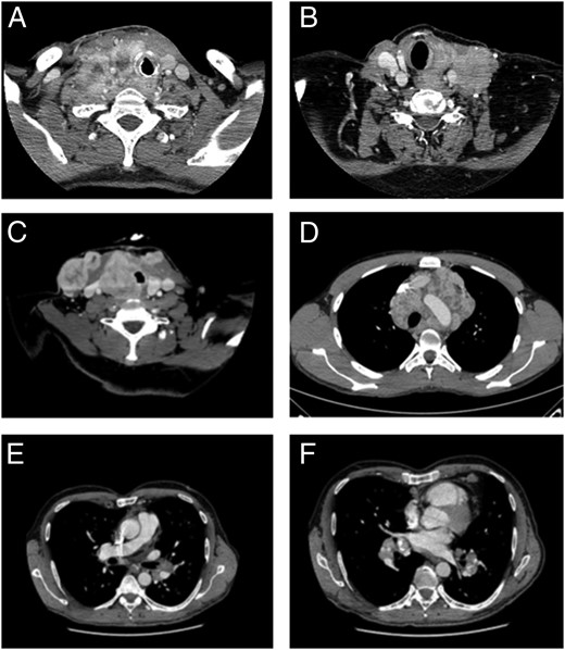 Airway invasion criteria.