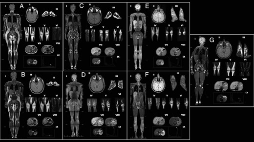 MRI scans and magnetic resonance spectroscopy findings of the controls and patients with CGL in each subgroup.