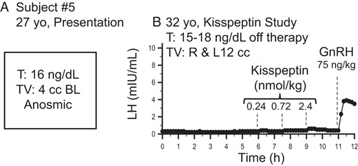 One male subject with reversal and relapse of hypogonadotropic hypogonadism at initial clinical presentation (A) and during the kisspeptin study (B).
