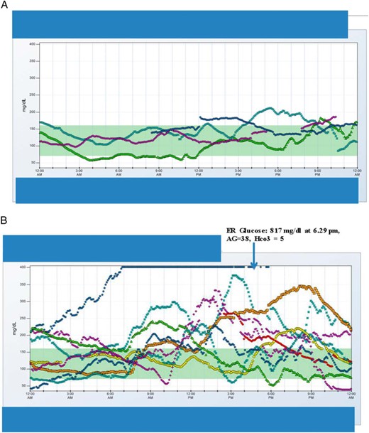 CGM data of patient A during a euglycemic DKA episode (A) and CGM data for patient B 1 day before and during hyperglycemic DKA (B) are shown.