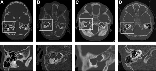 Malformation of the inner ear and vestibular structures in the patients with JPD show similar changes in all three patients: CT scans of head (upper panel), including inner ear and vestibular structures (lower panel) of (A) Patient 1 at 5 years of age, (B) Patient 2 at 15 months of age, (C) Patient 3 at age 4 years, and (D) a healthy child (boy, 34 months of age).