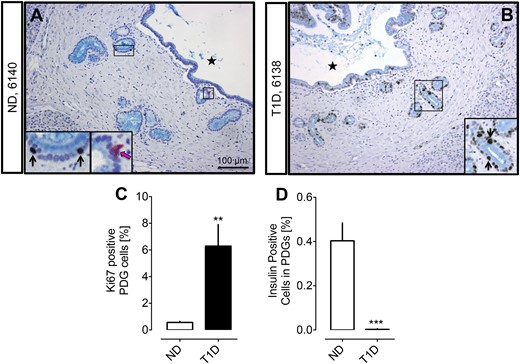 Examples of PDG compartments in ND (A) and subjects with T1D (B). Pancreas sections were stained by immunohistochemistry for insulin (pink), Ki67 (brown), and alcian blue with hemotoxylin counterstain. Insets, magnified areas of the low-power images marked by black rectangle. Black arrows indicate Ki67-positive nuclei in PDG cells. Pink arrows indicate insulin-positive PDG cells. Black stars indicate the interlobular duct lumen. (C) The frequency of replicating cells in the epithelium of PDGs is higher in T1D compared with ND (6.3% ± 1.6% vs 0.6% ± 0.1%, T1D vs ND, **P < 0.001). (D) The frequency of insulin-positive cells in the epithelium of PDGs is higher in ND compared with T1D (0.003% ± 0.002% vs 0.40% ± 0.08%, T1D vs ND, ***P < 0.0001). White bars = ND, black bars = T1D. Scale bar, 100 μm.