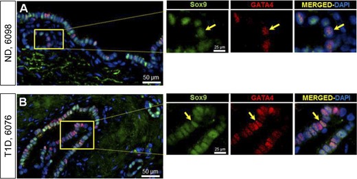 Examples of PDG cells expressing Sox9-GATA4 in pancreas from an adult ND (A) and in an adult T1D donor (B). Individual layers stained for Sox9 (green) and GATA4 (red) are shown along with merged (with 4′,6-diamidino-2-phenylindole) images. Insets, higher magnification of individual layers as marked by the yellow square in the low-power images. Yellow arrows indicate a PDG cell costaining for Sox9 and GATA4. Scale bars, 50 µm (for low-power images) and 25 µm (for insets).