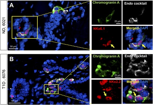 Examples of PDG cells expressing chromogranin A, NKx6.1, and endocrine cocktail (insulin, glucagon, somatostatin, pancreatic polypeptide, and ghrelin) in pancreas from an adult ND donor (A) and chromogranin A, NKx2.2, and endocrine cocktail in an adult T1D donor (B). Individual layers stained for NKx6.1/NKx2.2 (red), endocrine cocktail (insulin, glucagon, somatostatin, pancreatic polypeptide, and ghrelin) (white), and chromogranin A (green) are shown along with the merged (with 4′,6-diamidino-2-phenylindole) image. Insets, higher magnification of individual layers as marked by the yellow square in the low-power images. Yellow arrows indicate a PDG cell costaining for Nkx6.1, chromogranin A, and a cocktail of all the endocrine hormones (A) or Nkx2.2, chromogranin A, and a cocktail of all the endocrine hormones (B). Scale bars, 50 µm (for low-power images) and 25 µm (for insets).