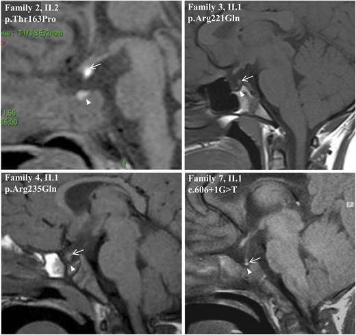 Sagittal MRI views of the index patients from families 2, 3, 4, and 7. Images show EPP and sella turcica anomalies. White arrows show the posterior pituitary and white arrowheads indicate the sella turcica.