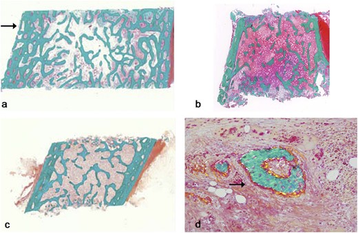 Histological images (Goldner Trichome staining) from transiliac bone biopsies naïve to BP therapy. (a) Patient 3 (male, age 15 years): note increased trabecular density compared with control and trabecularization of the cortex (arrow). (b) Patient 5 (female, 10 years of age): note the relatively thin cortex and normal trabecular bone. (c) Healthy control sample (female, age 9.4 years). (d) Patient 5: note the presence of woven bone (arrow), which is atypical in this location.
