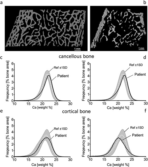 Quantitative backscattered images depicting cortical dimensions and trabecular network (a, b) and BMDD histograms of cancellous (c, d) and cortical (e, f) bone from transiliac biopsy samples of patients 3 (left) and 5 (right). BMDD results of cancellous and cortical bone are compared with reference BMDD from healthy children (gray band) (26). The corresponding parameters are given in Table 2. Ca, calcium; ref, reference; SD, standard deviation.