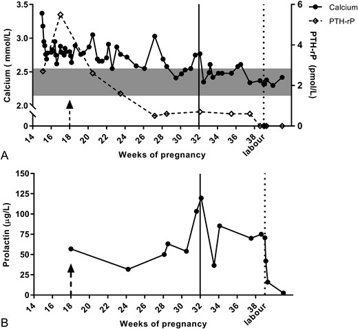 (A) Calcium, PTH-rP, and (B) prolactin values throughout pregnancy and after delivery at week 39. (A) Immediately at presentation, saline infusions were started, resulting in a decrease of calcium but not of PTH-rP. After introduction of dopamine agonist therapy (bromocriptin) at week 18 (arrow), PTH-rP values decreased, directly followed by a decline in calcium until normal values were reached. PTH-rP was hardly detectable from week 27 onward. Saline infusions were ended by week 32 (line) without recurrence of hypercalcemia. After labor (dotted line), calcium remained stable within normal range. (B) Prolactin levels stabilized with bromocriptin therapy rather than the physiological and expected rise in pregnancy. Few missed doses of bromocriptin around week 32 resulted in a transient rise in prolactin and calcium. Gray box represents normal ranges of serum calcium. Arrow indicates start of dopamine agonist therapy at week 18. Line indicates end of saline infusions. Dotted line indicates labor.