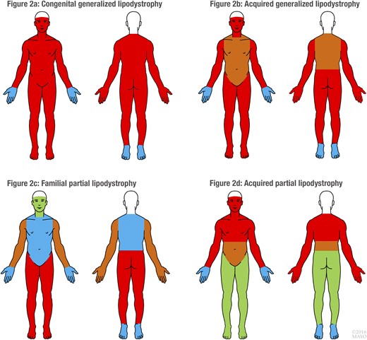 Distribution of adipose tissue in 4 major lipodystrophies (CGL, AGL, FPL, APL). Red, fat loss in >72% patients; brown, fat loss in 57% to 72% patients; blue, fat loss in <57% patients; and green, fat sparing. Please refer to Table 1 for the exact reported frequencies of the sites of fat loss in each of the 4 major lipodystrophies. For the purposes of uniformity in the pictorial representation, frequency cutoffs of >72%, 57% to 72%, and <57% were used.