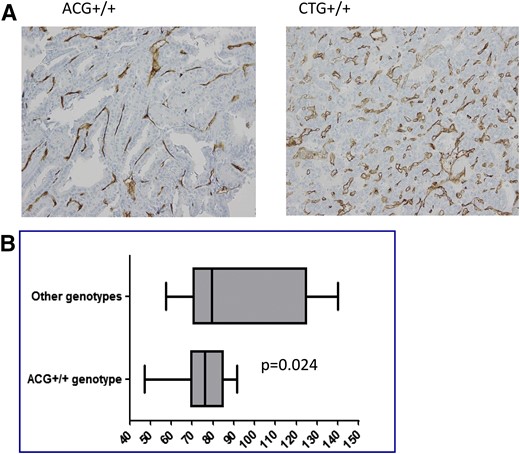 (A) Anecdotal comparison of primary tumor MVD, as estimated by CD34, between 2 DTC patients carrying the ACG+/+ and the CTG+/+ genotypes. High magnification, ×200. (B) Comparison of MVD, as estimated by CD34, in primary tumors from DTC patients carrying the ACG+/+ vs other genotypes. Analysis performed by means of the Mann-Whitney U test. Median, ranges, and confidence intervals are reported for each group.