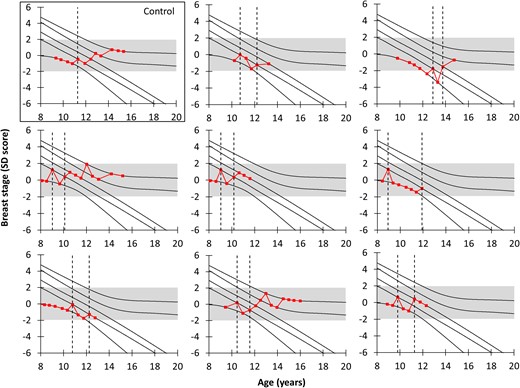 TT and subsequent breast development (nomogram). Eight randomly selected and representative girls with TT and 1 girl without (for comparison) plotted on the nomogram for breast stages. The dotted lines represent the time point(s) with onset(s) of breast development. The gray-shaded area represents ±2 SD; all girls with TT end in the gray-shaded area.