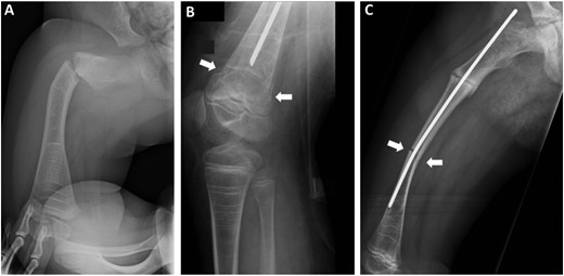 Examples of different fracture types. Three separate femoral fractures occurred in a girl with type III OI. She has been treated with BP since the age of 1 month. (A) A transverse fracture in the subtrochanteric region of the femur occurred at 1.9 years of age. (B) A transverse fracture of the distal femur, shown by white arrows, occurred at 7.4 years of age. (C) An oblique fracture of the femoral shaft, shown by white arrows, occurred at 8.3 years of age (a partially ossified fracture in the subtrochanteric region is also visible). Note the dense lines (Harris lines) caused by cyclic intravenous BP treatment in all three radiographs.