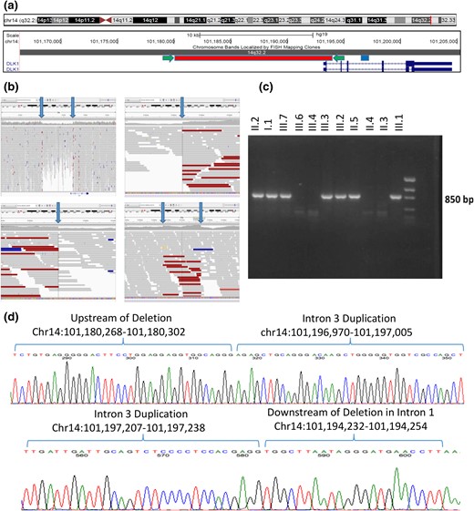 Complex genomic rearrangement resulting in deletion of exon 1 of DLK1. (a) Screenshot of DLK1 region from the University of California Santa Cruz Genome Browser including two RefSeq DLK1 transcripts in dark blue. The region of the genomic deletion is highlighted in red, and the region of the duplication is highlighted in blue. The location of the PCR primers used to amplify the sequence of the deletion (c and d) are indicated by green arrows. (b) Screenshots from the Integrative Genomics Viewer of whole-genome data from subject III.2. In each panel, the top track lists the genomic coordinates shown on the screen. The middle section shows individual sequencing reads as gray bars with a histogram of individual base coverage above the reads. The colored reads represent individual paired-end sequence reads whose paired read is not located at the expected distance. This occurs due to the deletion/genomic rearrangement. Top left panel: overview of genomic region including DLK1 and its upstream region. The heterozygous deletion is clearly visible in the middle of the panel as a region of decreased sequencing coverage. The location of the DLK1 gene is noted at the bottom of this panel. Bottom left panel: zoomed-in view of the beginning of the deletion demonstrating a precipitous drop in sequencing coverage along with an abundance of reads with pairs at an unexpected distance. Top right panel: zoomed-in view of the end of the deletion. Bottom right panel: area of duplication in intron 3 of DLK1 showing increased coverage and abundance of reads with pairs at an unexpected distance. Blue arrows in all panels indicate the boundaries of the deletion or duplication. (c) PCR products demonstrating segregation of the deletion in the family. PCR primers span the deletion, and only individuals with the deletion demonstrate a PCR product of ∼850 bp. Subjects II.1, II.8, and III.5 were also tested and do not carry the deletion (data not shown). (d) Sanger sequencing of the PCR products in a subject with the complex genomic rearrangement. The sequence from intron 3 has been duplicated and inserted between the two ends of the large deletion. This results in a sequence that starts upstream of the deletion and then includes the whole duplicated region of intron 3 and concludes downstream of the deletion. The top panel’s sequence begins upstream of the deletion and shows the breakpoint where the upstream region joins the beginning of the duplicated region from intron 3 of DLK1. The bottom panel’s sequence starts with the end of the intron 3 duplicated region and joins to the region immediately downstream of the deletion in intron 1 of DLK1. All coordinates are given in the Genome Reference Consortium build 37.