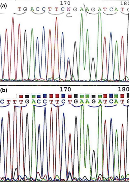 (a) Chromatogram demonstrating germline heterozygous SDHB c.268C>T, p.Arg90* mutation. (b) Chromatogram from the tumor demonstrating the SDHB c.268C>T, p.Arg90* mutation accompanied by loss of the wild type allele consistent with loss of heterozygosity.