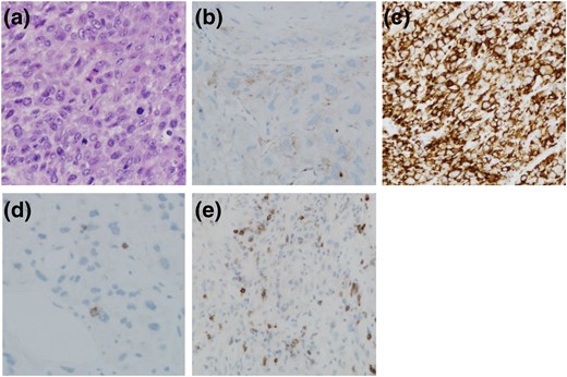 Representative photomicrographs showing (a) hematoxylin and eosin–stained section of ATC, (b) section of ATC tumor mass showing low PD-L1 expression, (c) section of ATC tumor mass showing high PD-L1 expression, (d) section showing low PD-1 expression on inflammatory cells, and (e) section showing high PD-1 expression on inflammatory cells. Original magnification: a, c, and e, 200×; b and d, 400×.