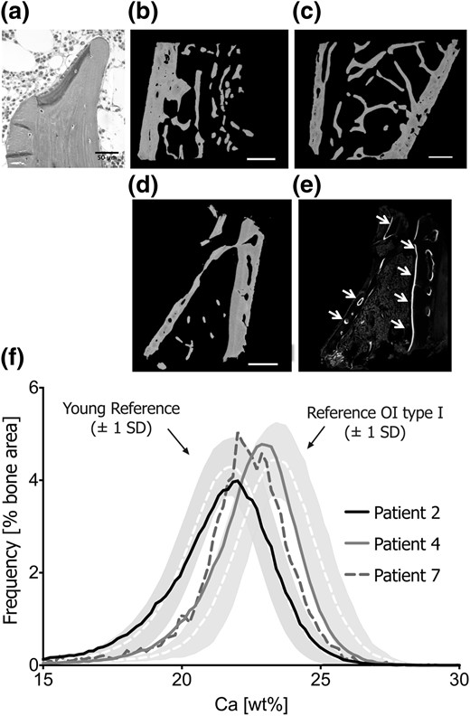 Bone tissue characteristics. Transiliac bone biopsy section of P2 under light microscopy (a) shows plump OBs forming an unmineralized matrix (dark gray). Mineralized matrix appears light gray (Goldner’s trichrome staining represents originally mineralized bone matrix in green, and osteoid in purple). Active bone formation was very rarely sighted. Backscattered images show bone biopsy samples from P2 (b), P4 (c), and P7 (c). The very low amount of trabecular bone tissue in P7’s sample is consistent with his severe skeletal phenotype. Under confocal laser-scanning microscopy, fluorescent double labels are detected on intracortical and endocortical bone surfaces (e; see white arrows), which does not reflect high bone remodeling but cortical bone apposition. (f) BMDD curves of cancellous bone of the three patients in relationship to pediatric reference values (20) and to patients with OI type I (23). Note that P4 has very low bone turnover and consequently the BMDD curve was right-shifted, reflecting higher average tissue age of the bone packets.