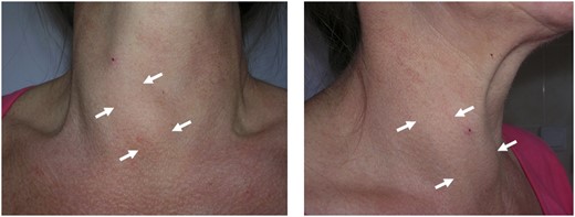 Compensatory enlargement of the right lobe in a patient with late-diagnosed left-sided THA.