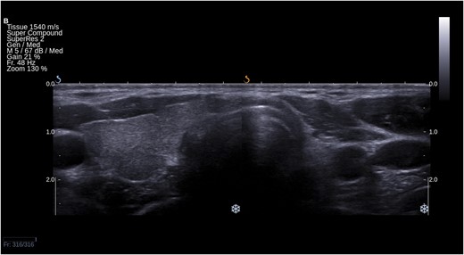 Ultrasound picture of left-sided THA in a transverse section of the neck. Right lobe and isthmus are present.