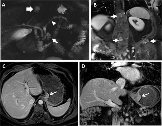 Representative radiographic GI findings in MAS. (A) MRCP imaging from a 55-year-old man shows diffuse dilation of the main pancreatic duct (arrowhead) along with a cystic lesion in the pancreatic head (thin arrow). A biliary cyst is also seen (thick white arrow). (B) Coronal postcontrast image demonstrates heterogeneously enhancing lesions in the spine and left iliac wing (arrows) in the same patient, consistent with fibrous dysplasia of the bone. (C and D) MRCP images in the same patient who underwent distal pancreatectomy and removal of a gastroesophageal junction polyp are shown. (C) Axial and (D) coronal postcontrast T1-weighted images show the gastroesophageal junction polyp (arrows).