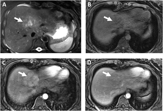 Representative hepatic lesions. (A‒D) MRCP imaging from a 22-year-old woman with MAS shows (A) a heterogeneous hyperintense mass in the dome of the liver on axial T2-weighted image (arrow). (B) The mass is hypointense on T1-precontrast image (arrow), (C) shows arterial enhancement on the T1-postcontrast arterial phase image (arrow), and (D) washout on the venous phase postcontrast image (arrow). The signal and enhancement characteristics are suggestive of an adenoma.