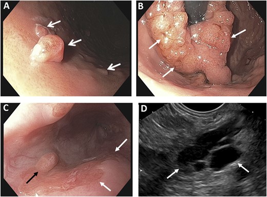 Representative endoscopic findings. (A) Several gastric polyps (arrows) are shown. (B) A retroflexed view shows the gastric cardia. The endoscope is seen as the black tube in the center of the image and is surrounded by a large mass (arrows), consistent with a gastric adenoma with high-grade dysplasia. (C) Endoscopic view of the distal esophagus shows a polypoid lesion (black arrow) and several flat lesions (white arrows). (D) Endoscopic ultrasonographic image of a large cyst (highlighted by arrows) is consistent with an IPMN in the pancreas.