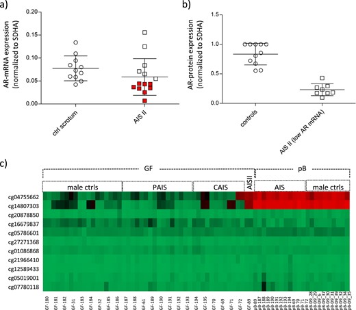 AR expression and AR promoter DNA methylation levels in GFs from controls and individuals with AIS. (a) AR mRNA expression in control GFs (n = 11) and GFs from patients with AIS type II (n = 14) as measured by quantitative PCR. AR mRNA levels were normalized to the housekeeping gene SDHA and are shown as mean of three independent measurements. AR mRNA levels below the SD are indicated in red. (b) AR protein measurement in control GFs and GFs from patients with AIS type II with reduced AR mRNA expression. Shown are all controls and patients with AIS type II indicated in red in panel (a) (GF-40, GF-89, GF-107, GF-109, GF-174, GF-176, GF-177, GF-179). (c) Heatmap of CpG methylation in the promoter region of the AR as present on the Human-Methylation27 DNA Analysis BeadChip. Depicted are DNA methylation levels from 9 control GF, 14 AR mutation–positive AIS II–derived GFs, and 1 AIS type II–derived GF, as well as from peripheral blood (pB) of a selection of patients with AR mutation–positive AIS and of independent male controls. All samples were run in duplicates. For pB samples, mean values of the duplicates are shown. Red indicates high DNA methylation; green indicates low DNA methylation. ctrls, controls; PAIS, partial androgen insensitivity syndrome.