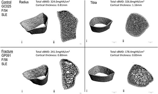 Representative 3D reconstructions of images of distal radius and distal tibia obtained with HR-pQCT from a female patient with SLE with a prevalent vertebral fracture (lower panel) and her age-matched control without fracture (upper panel): i, cortex; ii, combined cortical and trabecular.