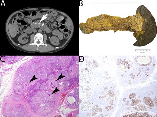 Radiology and surgical pathology. (A) CT abdomen demonstrating pancreatic enlargement and calcification (arrow). (B) Gross appearance of distal pancreatectomy and splenectomy demonstrating brawny induration and nodularity of the pancreas corresponding to myriad coalescing tumors (weight of distal pancreas removed, 264 g). (C) Photomicrograph of pancreas showing multiple hyperplastic islets coalescing into small neuroendocrine tumors. Dystrophic calcification (arrowheads) is noted (hematoxylin and eosin, ×100). (D) Glucagon immunohistochemistry demonstrating diffuse expression in hyperplastic islets and small tumors (glucagon immunohistochemistry, ×100).