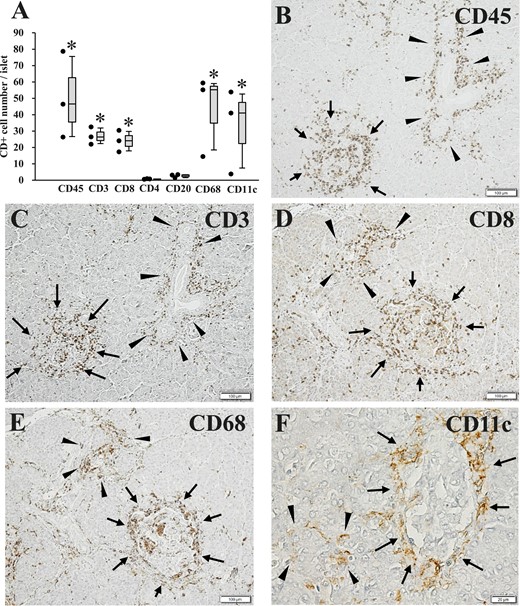 Number of CD+ MNCs in the islets of FT1DM, as well as pathological changes of islets, pancreatic ducts, and exocrine acinar tissues in FT1DM. (A) Number of CD+ cell subsets in the islets of FT1DM. *P < 0.05 for cell numbers in FT1DM compared with the nondiabetic control group. Increased MNC subsets are mainly composed of CD8+ T cells, CD68+ macrophages, and CD11c+ dendritic cells. (B) Extensive CD45 (leukocyte common antigen)+ MNC infiltration in and around the islets (arrows) and pancreatic ducts (arrowheads) in FT1DM. Immunoperoxidase staining. Original magnification, ×100; scale bar, 100 μm. (C) CD3+ T cells infiltrating in and around the islets (arrows) and pancreatic ducts (arrowheads) of FT1DM. Serial section with (B). Immunoperoxidase staining. Original magnification, ×100; scale bar, 100 μm. (D) CD8+ T cells infiltrating in and around the islets (arrows) and exocrine acinar tissue (arrowheads) of FT1DM. Immunoperoxidase staining. Original magnification, ×100; scale bar, 100 μm. (E) CD68+ macrophages infiltrating in and around the islets (arrows) and exocrine acinar tissues (arrowheads) in FT1DM. Serial section with (D). Immunoperoxidase staining. Original magnification, ×100; scale bar, 100 μm. (F) CD11c+ dendritic cells showing characteristic infiltration around the islets (arrows) and partial infiltration around pancreatic acinar tissues (arrowheads) in FT1DM. Immunoperoxidase staining. Original magnification, ×500; scale bar, 20 μm.