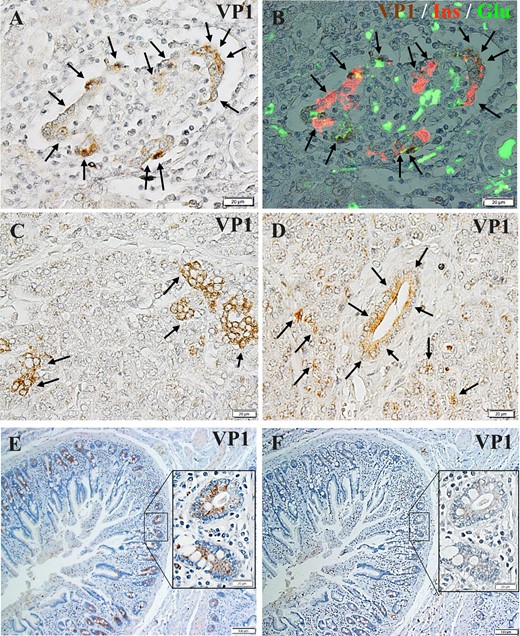 Enterovirus-related protein VP1 expression in islet cells, exocrine acinar cells, and pancreatic ductal cells. (A) Islets of FT1DM were positive for VP1 (arrows). Immunoperoxidase staining. Original magnification, ×500; scale bar, 20 μm. (B) Triple immunostained merged image of islets stained for VP1 (brown), insulin (Ins, red), and glucagon (Glu, green). Original magnification, ×500; scale bar, 20 μm. (C) Pancreatic acinar cells of FT1DM were positive for VP1 (arrows). Immunoperoxidase staining. Original magnification, ×500; scale bar, 20 μm. (D) Pancreatic duct epithelial cells and acinar cells around ducts of FT1DM were positive for VP1 (arrows). Immunoperoxidase staining. Original magnification, ×500; scale bar, 20 μm. (E) VP1 (brown) was stained densely in the duodenal mucosa with FT1DM (case 1). Immunoperoxidase staining. Original magnification, ×500; scale bar, 20 μm. (F) VP1 staining was abolished by absorption of an excessive concentration (20 μg/mL) of VP1 protein. Serial section of (E). Original magnification, ×500; scale bar, 20 μm.