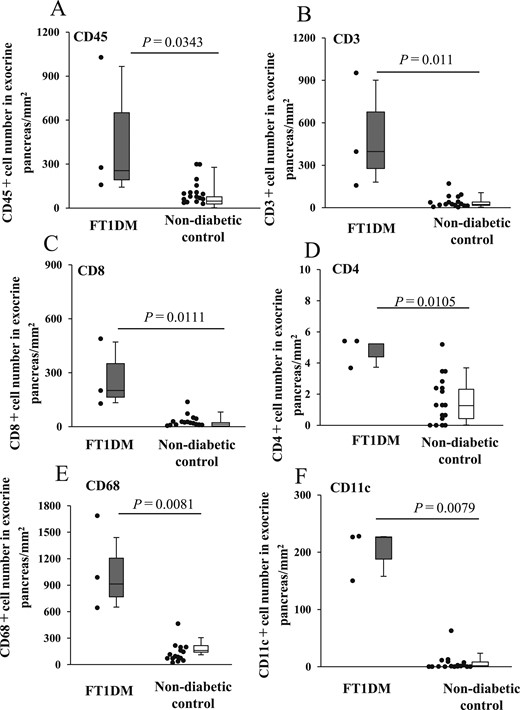 Number of infiltrating MNC subsets to exocrine pancreatic tissues and islets of FT1DM and nondiabetic control. (A) Number of CD45+ MNCs in the exocrine pancreas of FT1DM and control groups. (B) Number of CD3+ T cells in the exocrine pancreas of FT1DM and control groups. (C) Number of CD8+ T cells in the exocrine pancreas of FT1DM and control groups. (D) Number of CD4+ T cells in the exocrine pancreas of FT1DM and control groups. (E) Number of CD68+ macrophages in the exocrine pancreas of FT1DM and control groups. (F) Number of CD11c+ dendritic cells in the exocrine pancreas of FT1DM and control groups.