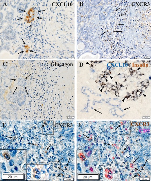 CXCL10 and CXCR3 expression in pancreatic exocrine tissues in FT1DM. (A) CXCL10 (brown) was expressed in small ductal cells (arrows). Immunoperoxidase staining. Original magnification, ×500; scale bar, 20 μm. (B) CXCR3+ (brown) cells located around the CXCL10+ exocrine cells (arrows). Serial section with (A). Immunoperoxidase staining. Original magnification, ×500; scale bar, 20 μm. (C) The serial section was negative for glucagon staining, confirming that CXCL10+ cells are not endocrine cells (arrows). Immunoperoxidase staining. Original magnification, ×500; scale bar, 20 μm. (D) Double immunostained merged image of islets and pancreatic ductal cells stained for CXCL10 (blue) and insulin (brown) in FT1DM. Most β cells were positive for CXCL10 (arrowheads), and some pancreatic ductal cells were positive for CXCL10 (blue, arrows). Immunoperoxidase staining. Original magnification, ×500; scale bar, 20 μm. (E) Immunostaining of FT1DM pancreas for CXCR3 (brown). Some CXCR3+ MNCs infiltrated the islets and exocrine cells (arrows). Immunoperoxidase staining. Original magnification, ×500; scale bar, 20 μm. (F) Merged image of CXCR3 (E) stained by immunoperoxidase staining (brown) and CD3 (red) staining by an immunofluorescence method. A high proportion of CD3+ T cells infiltrating the islets were positive for CXCR3 (arrows). Insets show a magnified view. Original magnification, ×500; scale bar, 20 μm.