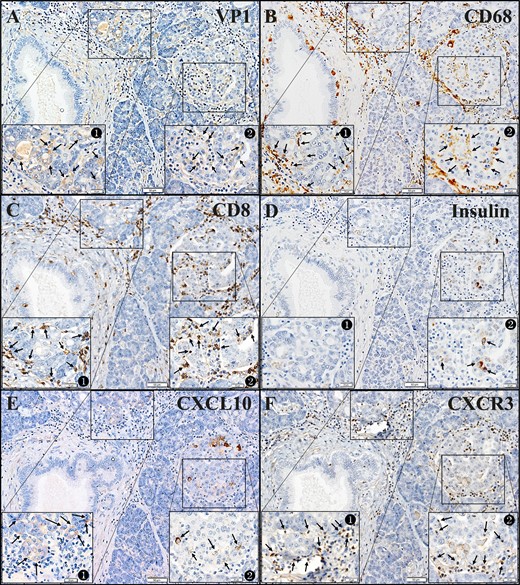 Correlation between the presence of enterovirus VP1 and inflammatory cell infiltration to acinar cells/islets and CXCL10/CXCR3 expression in the FT1DM pancreas. (A–F) Serial sections. Original magnification, ×100; scale bars, 50 μm (20 μm in each inset). See the magnified and detailed images of insets in an online repository (11). (A) VP1 in the FT1DM pancreas. Inset 1 shows VP1 in exocrine acinar tissues (brown, arrows). Inset 2 shows VP1 in islets (brown, arrows). (B) CD68+ macrophages (brown) infiltrate to the exocrine pancreatic tissues (inset 1, arrows) and islets (inset 2, arrows). (C) CD8+ T cells (brown) infiltrate to the exocrine pancreatic tissues (inset 1, arrows) and islets (inset 2, arrows). (D) A few β cells were densely stained for insulin (brown) in FT1DM islets (inset 2, arrows). Some β cells are stained faintly. (E) CXCL10 (brown) in exocrine pancreatic tissues (inset 1, arrows) surrounded by MNCs are stained faintly, and islets cells (inset 2, arrows) are densely stained for CXCL10. Remaining islet cells are faintly stained for CXCL10. (F) CXCR3+ MNCs (brown) infiltrate around the exocrine pancreatic tissues (inset 1, arrows) and islets (inset 2, arrows).